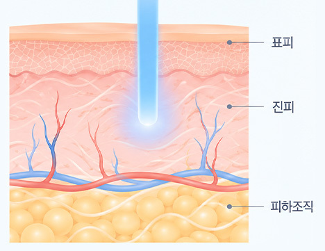 755nm 알렉산드라이트