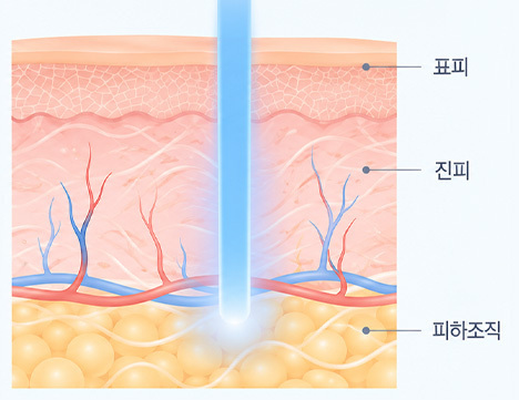 1064nm 엔디야그
